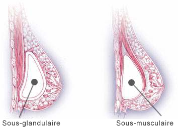 Emplacement de l'Implant